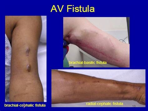 fistulae|Fistula .